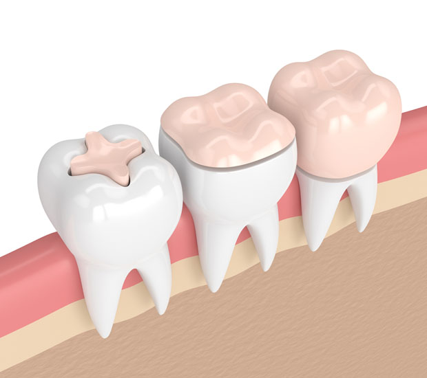 Atlanta Dental Inlays and Onlays