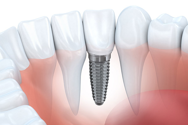 From Flipper Teeth To Dental Implants: When To Make The Switch